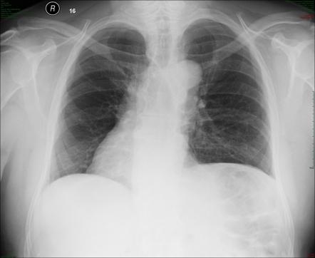 Dextrocardia Radiology Reference Article Radiopaedia Org