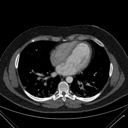 Myocardial infarction | Radiology Reference Article | Radiopaedia.org