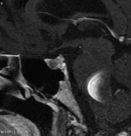 Pituitary adenoma PitNET Radiology Reference Article