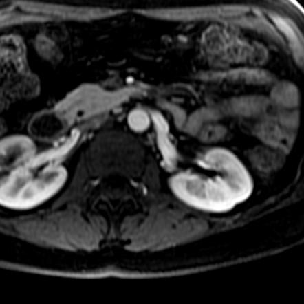 Pancreas divisum | Radiology Reference Article | Radiopaedia.org