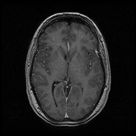 Idiopathic intracranial hypertension | Image | Radiopaedia.org