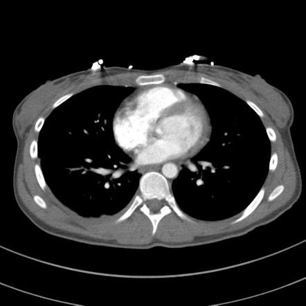 Traumatic renal artery dissection and pancreatic transection ...