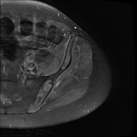 Diffuse Large B-cell Lymphoma: Skeletal Involvement | Image ...