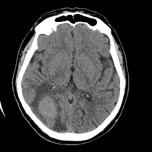 Melanoma metastases - brain and spine | Image | Radiopaedia.org