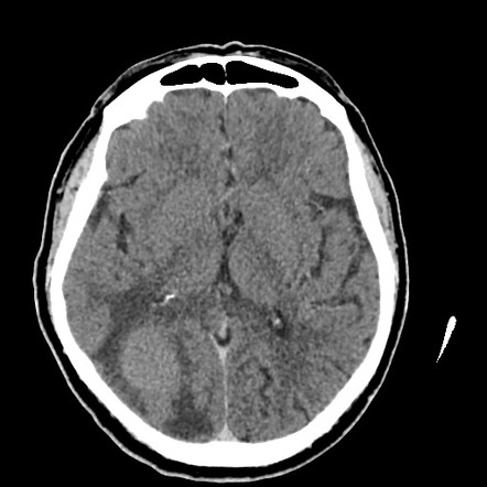 Melanoma metastases - brain and spine | Image | Radiopaedia.org