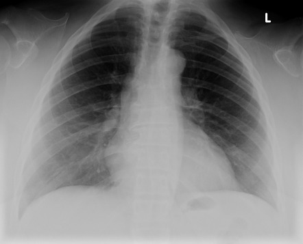 Playlist 'cxr Anatomical Variants' By Dr Henry Knipe