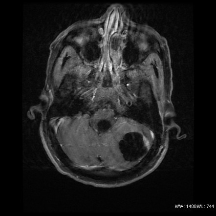 von-Hippel-Lindau disease (with hemangioblastoma) | Image | Radiopaedia.org