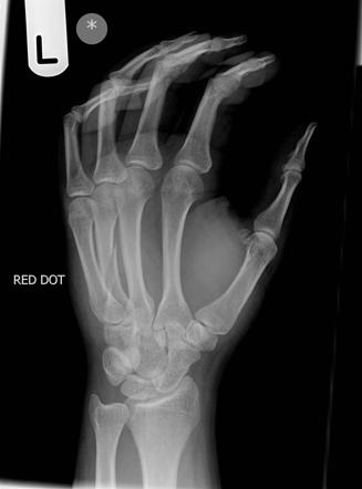 bankart fracture emedicine sinusitis