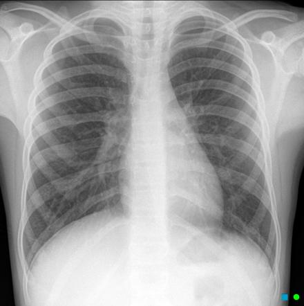 Viewing playlist: CXR 101: A Primer | Radiopaedia.org