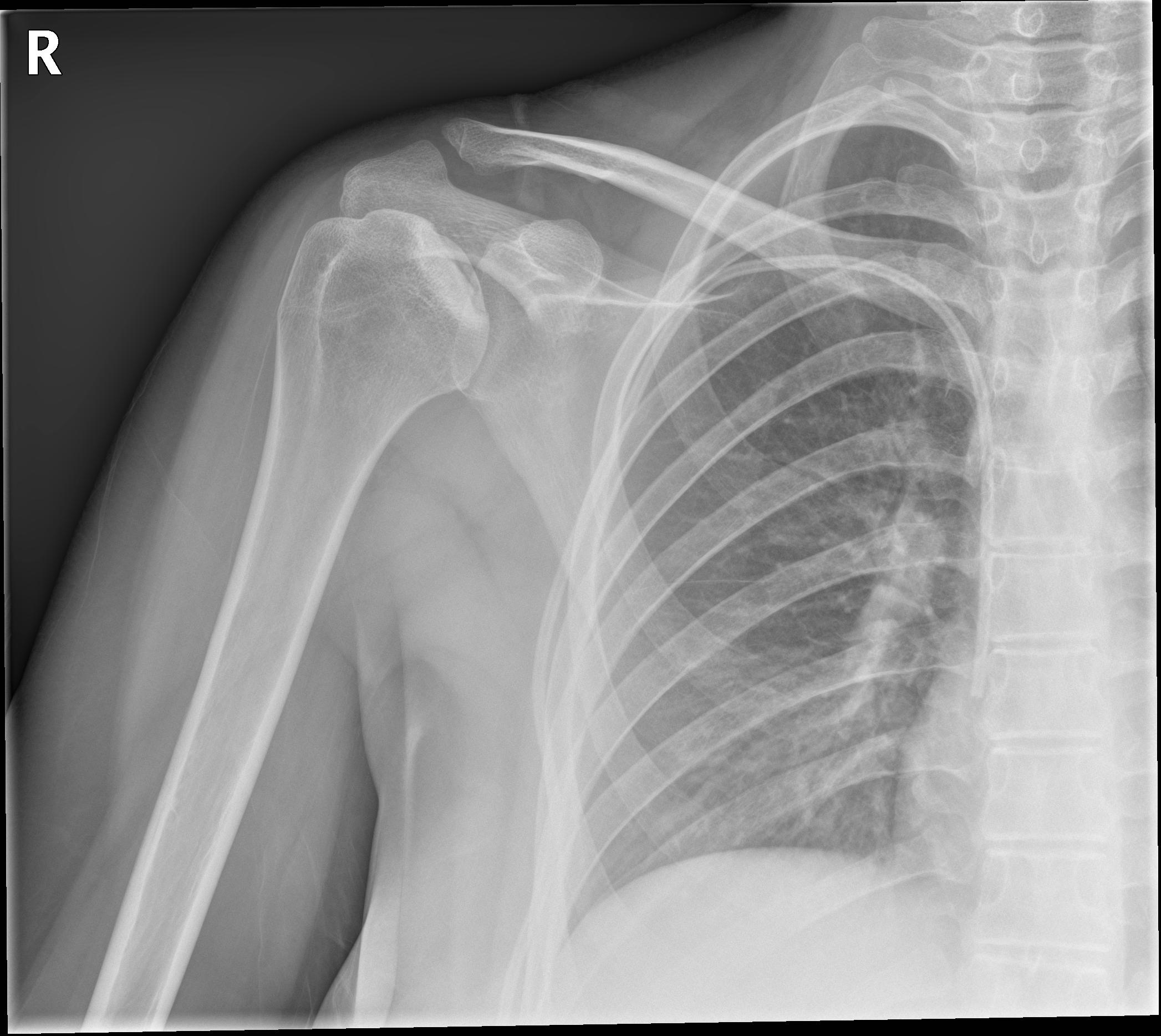 Bilateral Humeral Head Avascular Necrosis Image Radiopaedia Org My