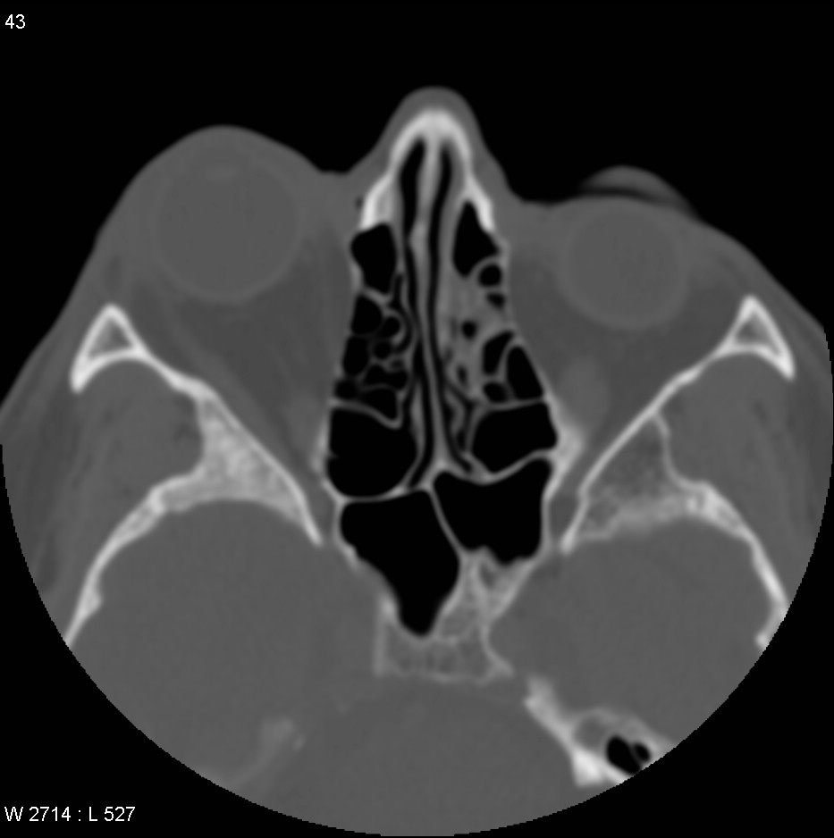 En plaque meningioma - sphenoid wing | Image | Radiopaedia.org