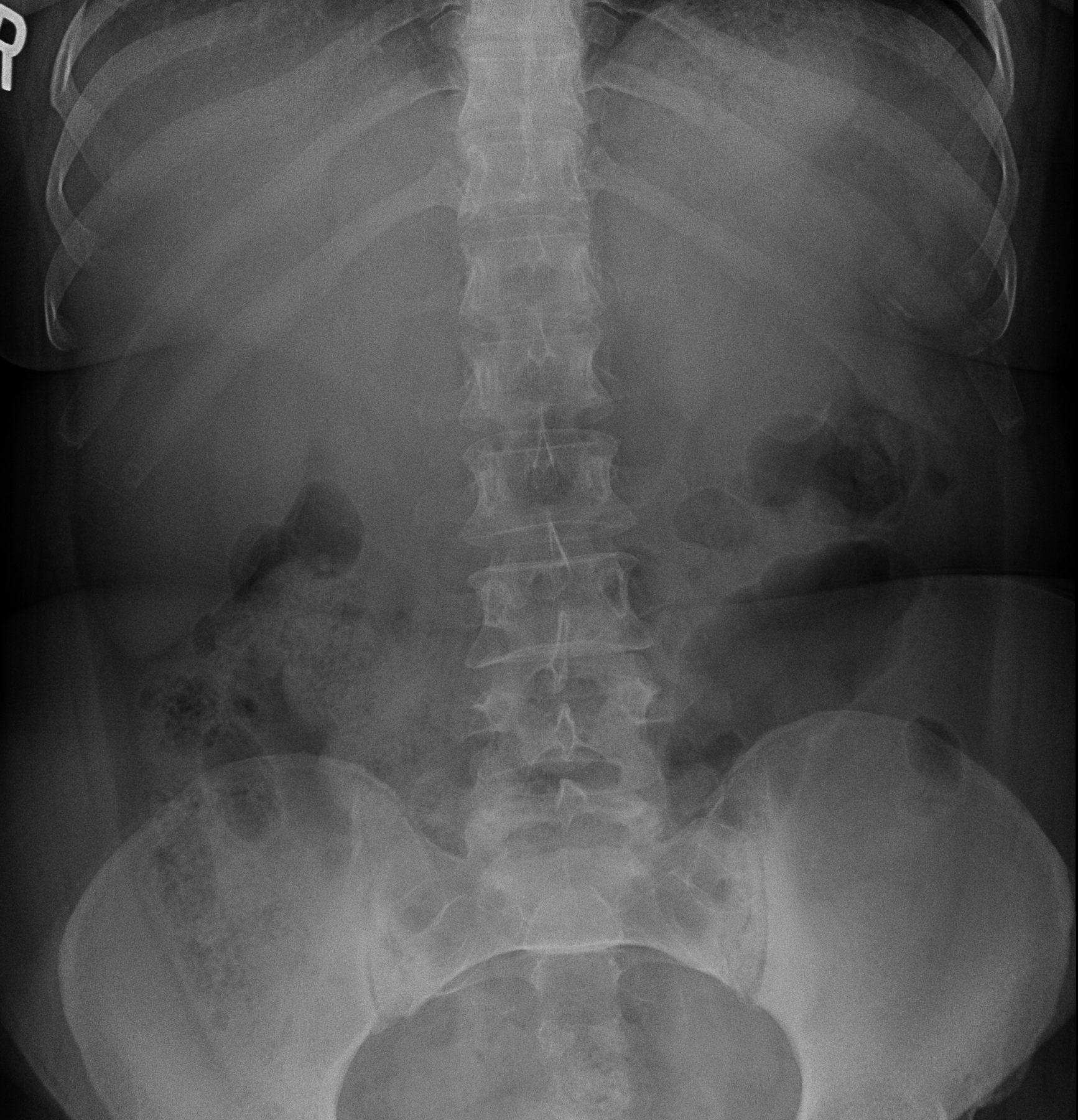 Pancreatic mucinous cystadenoma | Image | Radiopaedia.org