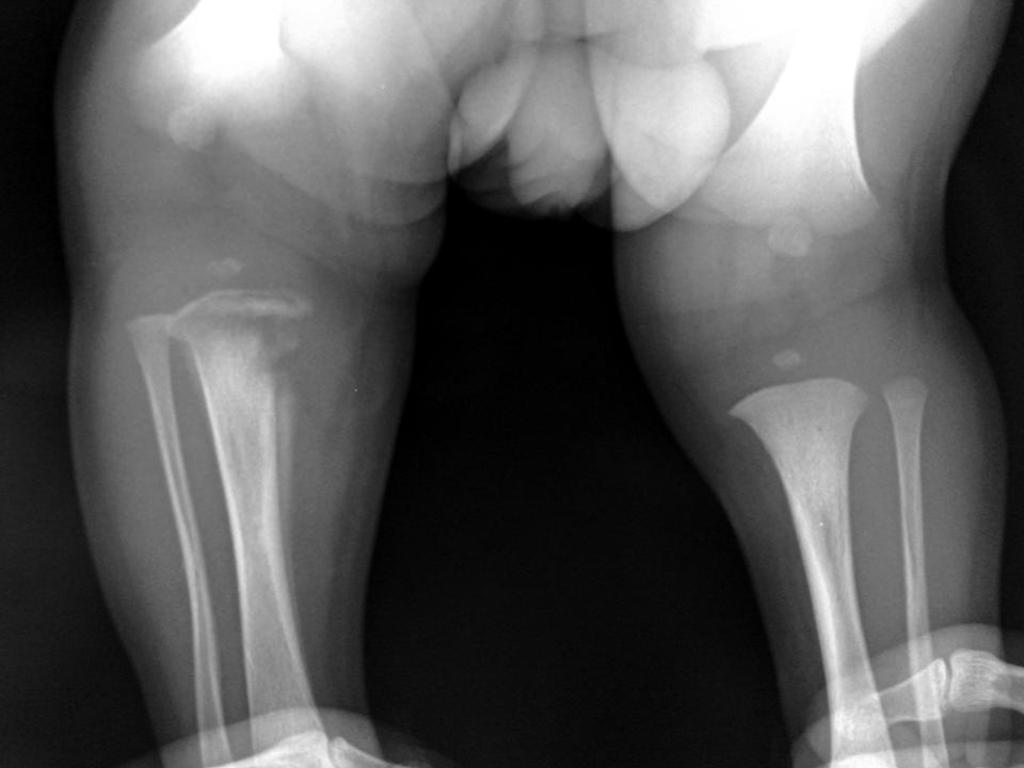 Эпифизарный остеомиелит. Гематогенный остеомиелит новорожденных. Эпифизарный остеомиелит рентген.