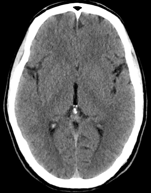 Normal CT head (cerebral and bone windows) | Image | Radiopaedia.org