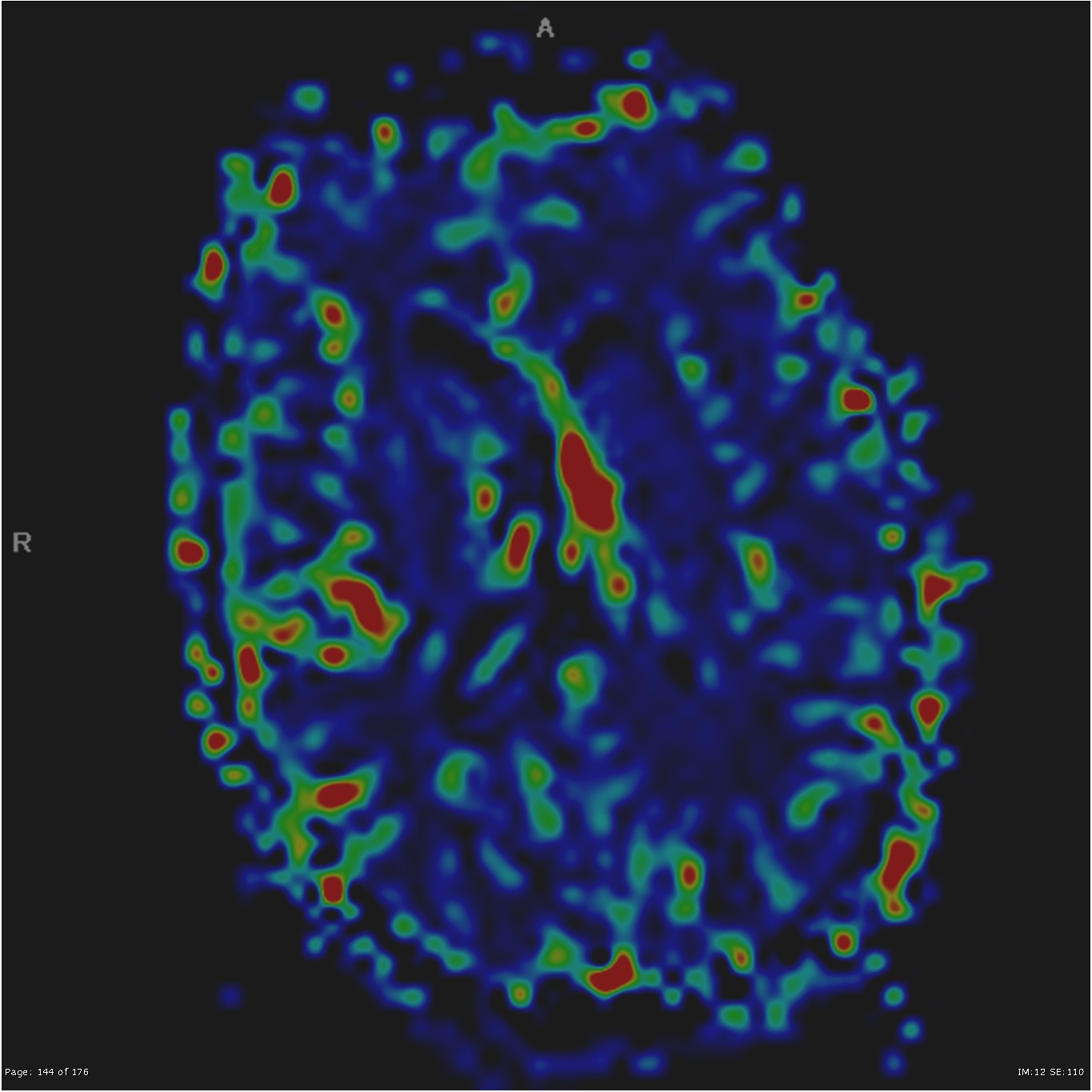 Subependymoma - lateral ventricle | Image | Radiopaedia.org