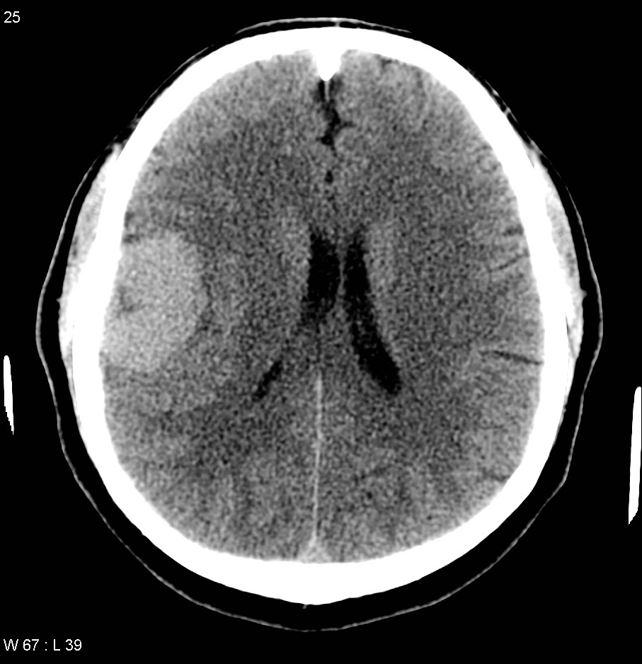 Meningioma with vascular pedicle | Image | Radiopaedia.org