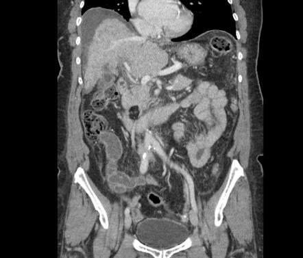 Pancreatic lipoma | Radiology Reference Article | Radiopaedia.org