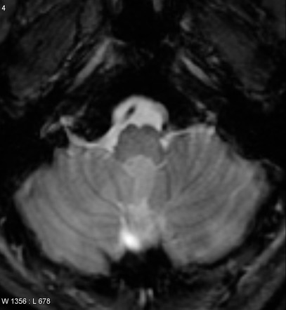 Subependymoma | Image | Radiopaedia.org