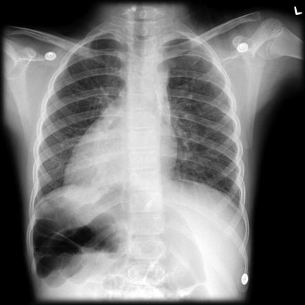 Dextrocardia | Radiology Reference Article | Radiopaedia.org