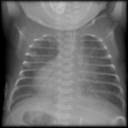 Kartagener syndrome | Radiology Reference Article | Radiopaedia.org