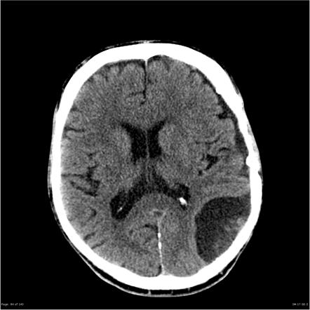 Microcystic meningioma | Radiology Case | Radiopaedia.org