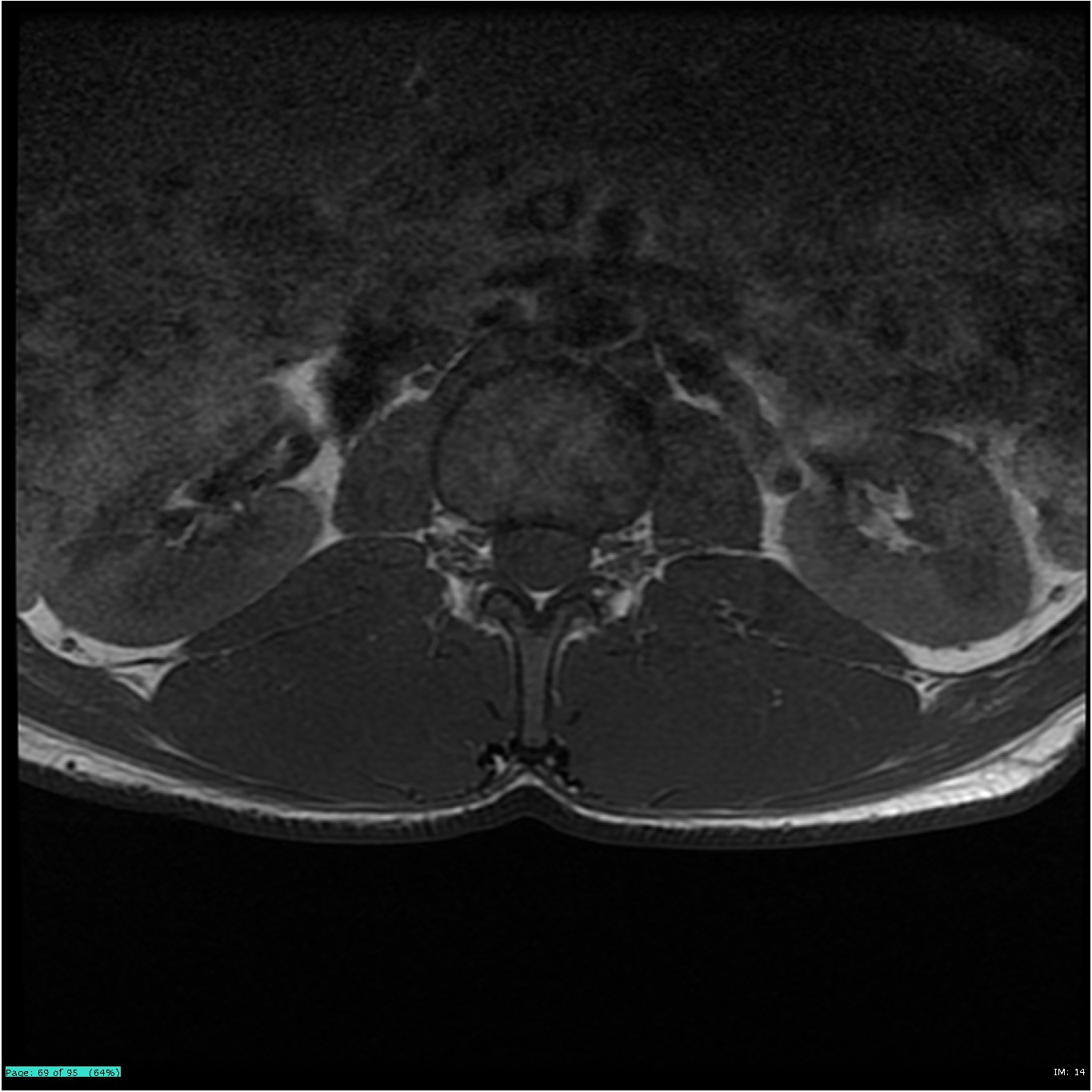 Normal Spinal Mri