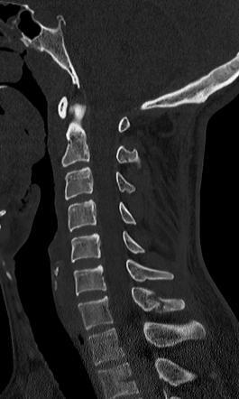 Clay-shoveler fracture | Radiology Case | Radiopaedia.org