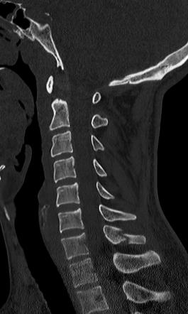 Clay-shoveler Fracture | Radiology Reference Article | Radiopaedia.org