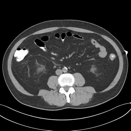 Cholecystitis with focal perforation and hepatic abscess | Radiology ...