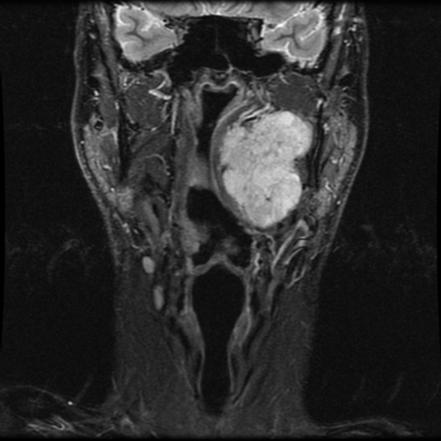 Pleomorphic Adenoma Of The Salivary Glands Radiology Reference Article Radiopaedia Org