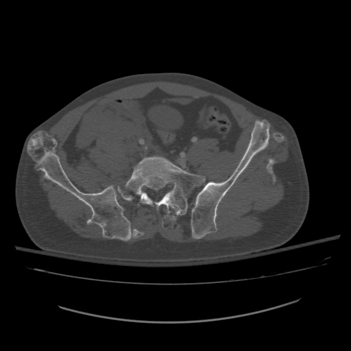 Hereditary multiple exostoses (HME) and pelvic trauma | Image ...