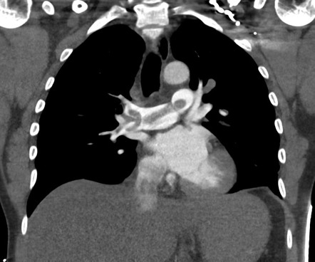 Saddle pulmonary embolus with right heart strain | Radiology Case ...