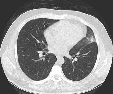 Pulmonary infarct | Image | Radiopaedia.org