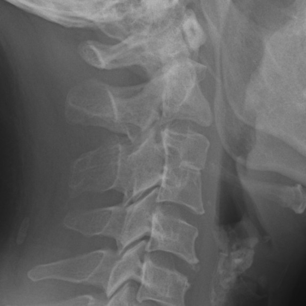 Конкресценция позвонков. Синдром Клиппеля-Фейля рентген. Клиппеля Фейля рентген. Аномалия Клиппеля-Фейля-Шпренгеля рентген. Болезнь Клиппеля Фейля.