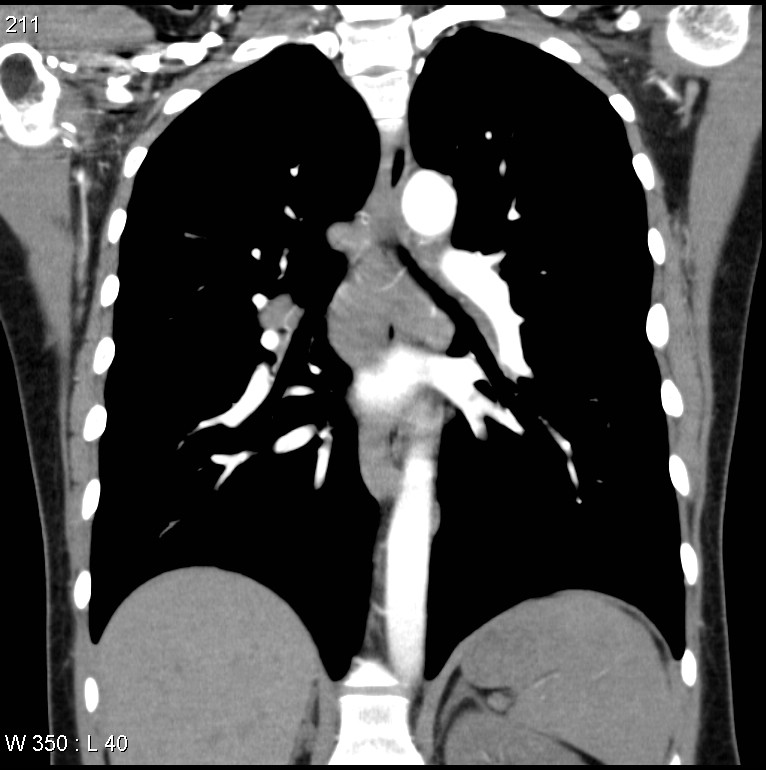 Pulmonary sarcoidosis | Image | Radiopaedia.org