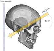 Skull (Towne view) | Radiology Reference Article | Radiopaedia.org