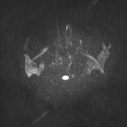 Acute Disseminated Encephalomyelitis | Image | Radiopaedia.org