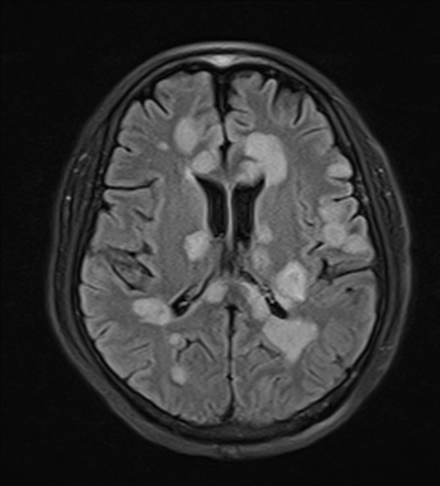 Encephalitis Mri