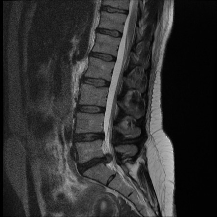 Disc extrusion - L5/S1 | Image | Radiopaedia.org