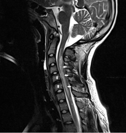 Fibrocartilaginous embolism | Radiology Reference Article | Radiopaedia.org