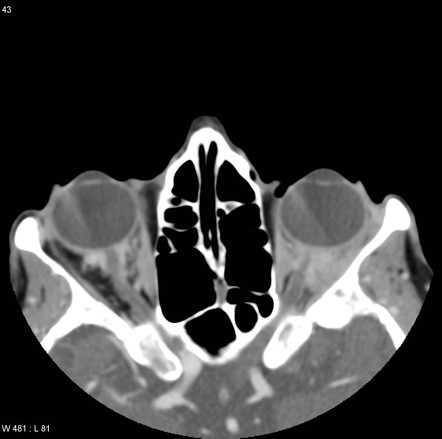 Orbital metastasis | Radiology Reference Article | Radiopaedia.org