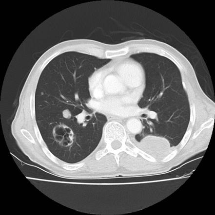 Metastatic Melanoma To Lungs (cavitating) 