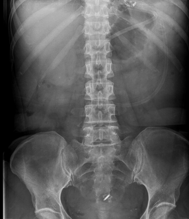 Roux limb obstruction | Radiology Case | Radiopaedia.org