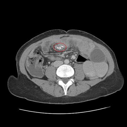 Viewing playlist: Small bowel obstruction | Radiopaedia.org