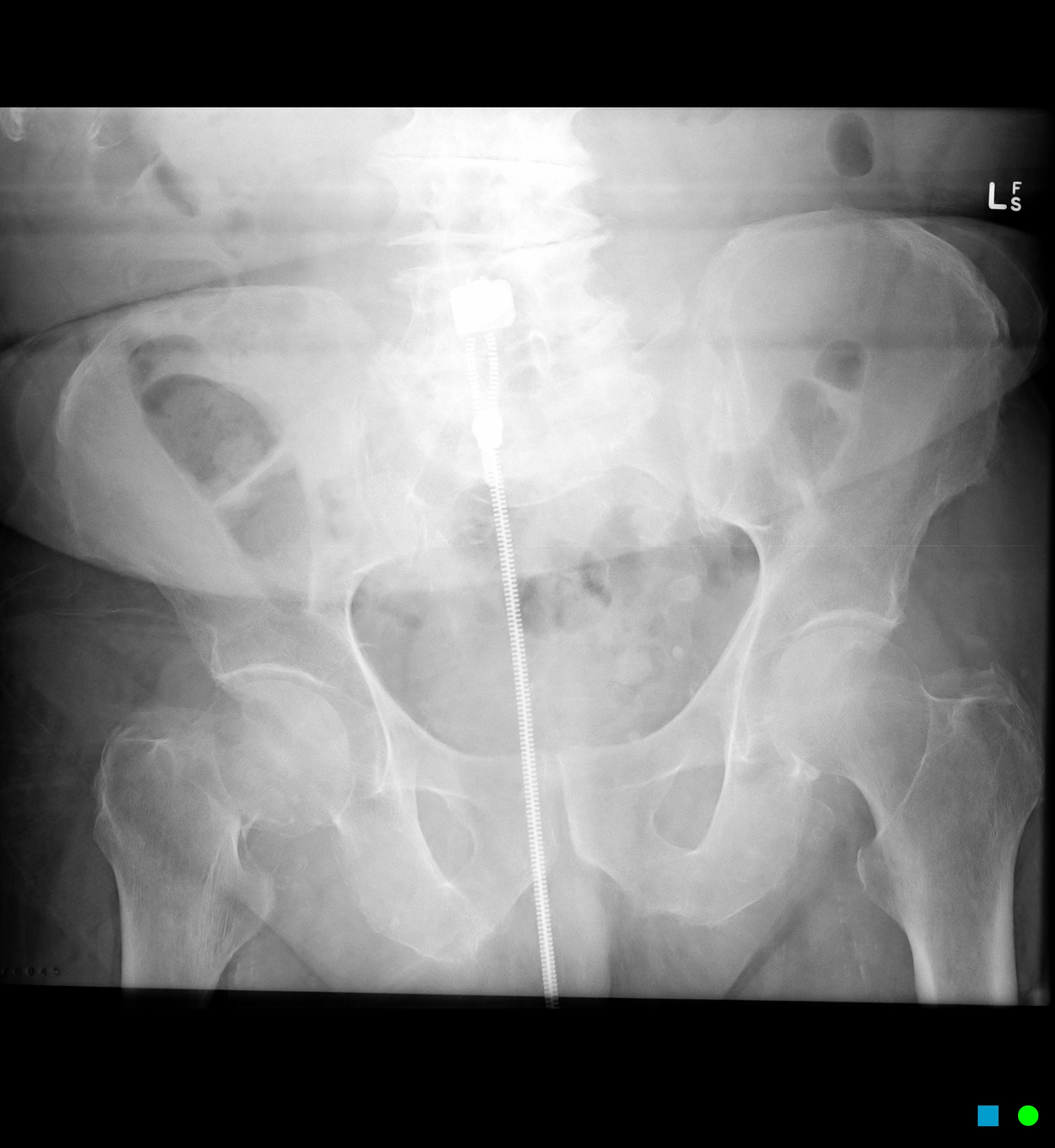 Fractured Neck Of Femur Garden Type Iii Image