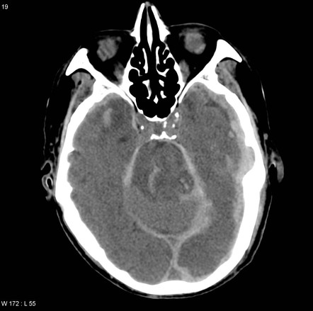 Duret hemorrhage | Radiology Reference Article | Radiopaedia.org