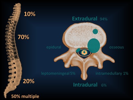 Spinal Metastasis 