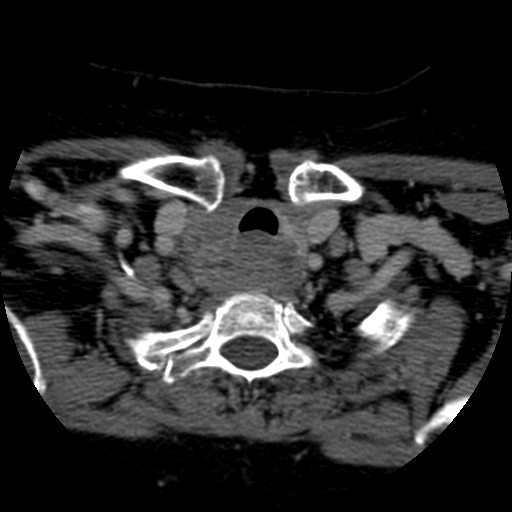 Thyroid lymphoma | Image | Radiopaedia.org