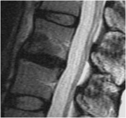 Hemispheric spondylosclerosis | Radiology Reference Article ...