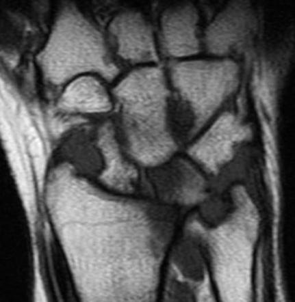 Rheumatoid Arthritis Musculoskeletal Manifestations Radiology Reference Article